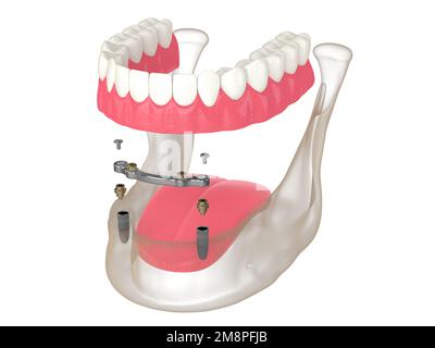 3D Render der Stange Retention Removable Overdenture Installation Support by two Implantates over white Stockfoto