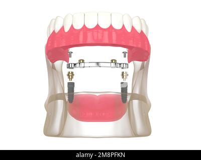 3D Render der Stange Retention Removable Overdenture Installation Support by two Implantates over white Stockfoto