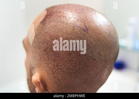 Rückansicht des kahlen männlichen Kopfes nach Haartransplantationschirurgie Stockfoto