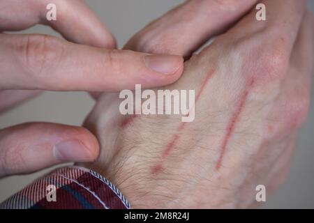 Nahaufnahme des Mannes, der die Hand mit Kratzern auf der Haut zeigt Stockfoto