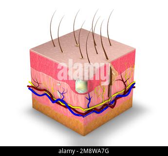 Hautabschnitt mit Zyste, subkutane Schwellung. Pilarzyste und Talgzyste. Hautpflege, Dermatologie. 3D-Rendering Stockfoto