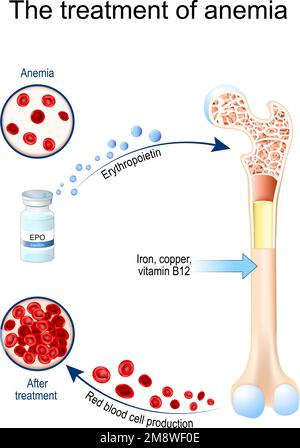 Erythropoietin und Anämiebehandlung. Glykoprotein-Zytokin, das die Produktion roter Blutkörperchen anregt. Erythropoese. Durchstechflasche mit EPO. Anämie Stock Vektor