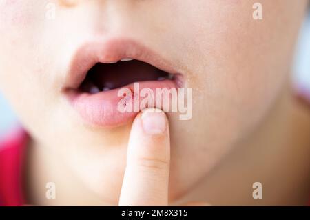 Kind berührt mit dem Finger eine blutige Lippe. Stockfoto