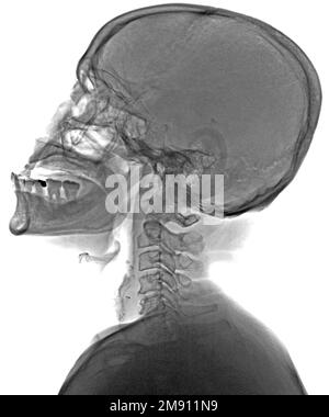 Schädelröntgenaufnahme in lateraler Ansicht Stockfoto