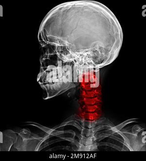 Nackenschmerzen. Film-Röntgenschädellaterale Ansicht und Halswirbelsäule. Stockfoto