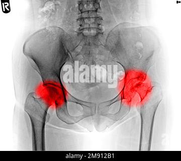Röntgenfilmaufnahmen menschlicher Becken- und Facturhüftgelenke im roten Bereich Stockfoto