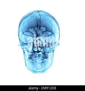 Röntgenfilmaufnahmen des normalen menschlichen Schädels auf isoliertem Hintergrund Stockfoto