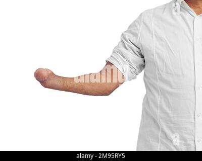 Invalidität, Amputierte und Arm eines behinderten Mannes mit Unterarmstumpf mit Modell. Isoliertes Invaliditätsmodell und weißer Hintergrund eines A. Stockfoto