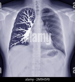 Fusion von Thorax-Röntgenbild und CT-Thorax-Koronalansicht bei Lungeninfektion aus dem Covid-19-Konzept. Stockfoto