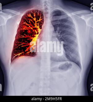 Fusion von Thorax-Röntgenbild und CT-Thorax-Koronalansicht bei Lungeninfektion aus dem Covid-19-Konzept. Stockfoto