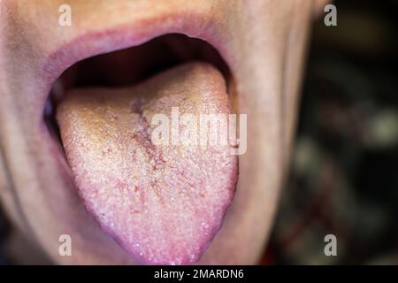 Männliche zeigt Überwucherung candidiasis auf seine Zunge Stockfoto