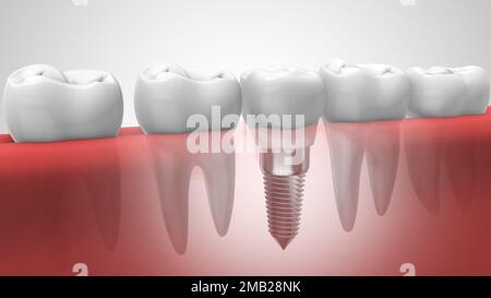 Dentales Implantat in der menschlichen Denturra 3D Abbildung Stockfoto