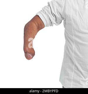 Invalidität, einzigartig und Armamputierte eines Mannes mit Verletzung am Unterarm mit Modell. Isoliertes, behindertes Modell und weißer Hintergrund eines Mannes Stockfoto