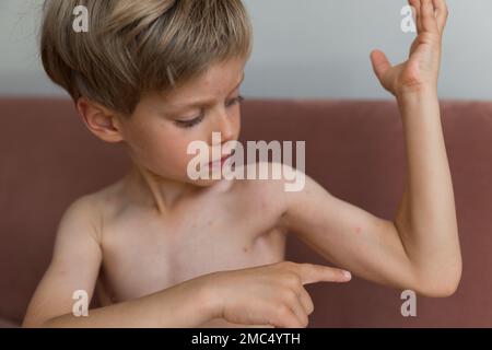 Jungkind mit Windpocken. Krankes Kind mit Windpocken. Varizellen-Virus oder Windpocken-Blasenausschlag bei Kindern. Porträt eines kleinen Jungen mit Pocken. Stockfoto