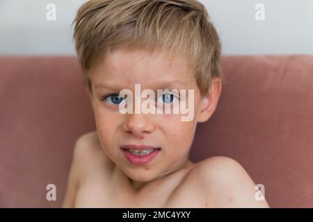 Jungkind mit Windpocken. Krankes Kind mit Windpocken. Varizellen-Virus oder Windpocken-Blasenausschlag bei Kindern. Porträt eines kleinen Jungen mit Pocken. Stockfoto