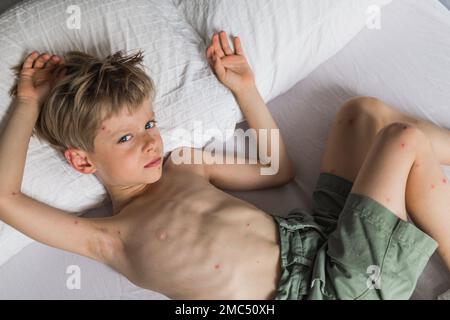 Jungkind mit Windpocken. Krankes Kind mit Windpocken. Varizellen-Virus oder Windpocken-Blasenausschlag bei Kindern. Porträt eines kleinen Jungen mit Pocken. Stockfoto