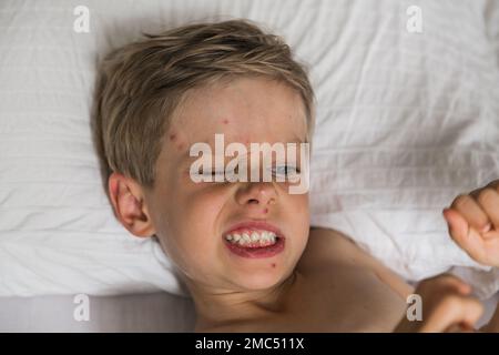 Jungkind mit Windpocken. Krankes Kind mit Windpocken. Varizellen-Virus oder Windpocken-Blasenausschlag bei Kindern. Porträt eines kleinen Jungen mit Pocken. Stockfoto