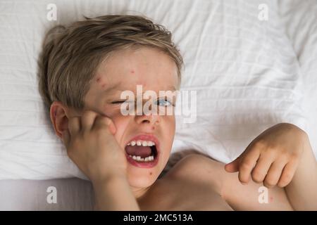 Jungkind mit Windpocken. Krankes Kind mit Windpocken. Varizellen-Virus oder Windpocken-Blasenausschlag bei Kindern. Porträt eines kleinen Jungen mit Pocken. Stockfoto