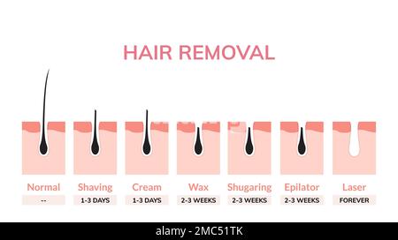 Haarentfernung Laser Behandlung Hautvektor Illustration Bikini kosmetische Licht medizinische Chirurgie Frau Achsellaser Haarentfernung. Stock Vektor