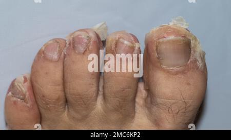 Detail der Peelings nach Scharlach bei einem erwachsenen Kaukasusmenschen Stockfoto