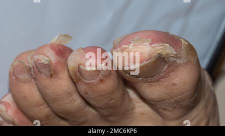 Detail der Peelings nach Scharlach bei einem erwachsenen Kaukasusmenschen Stockfoto