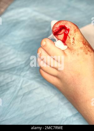 Nagelriss und Nagelbettblutung am kindlichen Bein. Sehr schmerzhafte Verletzung des Nagels des großen Zehens. Stockfoto