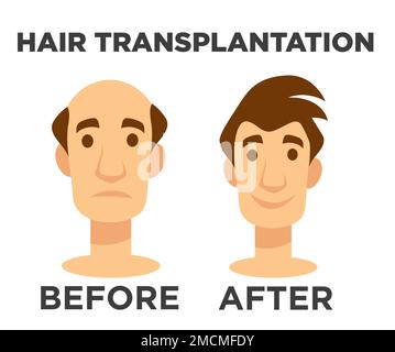 Haartransplantation vor und nach der Wirkung des Glatzköpfchens Stock Vektor