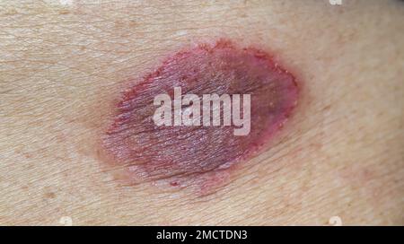 Tinea corporis oder Ringwurm. Juckende Hautläsionen am Abdomen einer älteren asiatischen Frau. Stockfoto