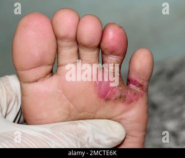 Pilzinfektion Tinea pedis am Fuss einer asiatischen Frau. Es ist eine juckende Läsion. Stockfoto