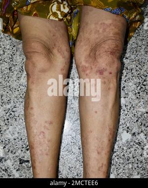 Pilzinfektion genannt Tinea corporis in Bein der asiatischen Frau. Weit verbreiteter Ringwurm über den unteren Extremitäten. Stockfoto