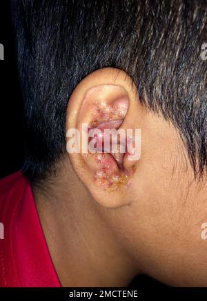 Multiple Impetigos oder zahlreiche Staphylokokken-Hautinfektionen im Ohr eines südostasiatischen Kindes. Stockfoto