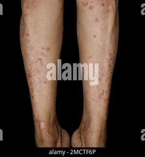 Pilzinfektion genannt Tinea corporis in Bein der asiatischen Frau. Weit verbreiteter Ringwurm über den unteren Extremitäten. Stockfoto