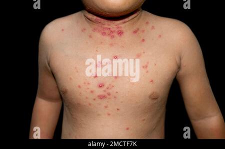 Molluscum contagiosum-Hautläsionen auch Wasserwarzen des asiatischen Kindes genannt. Stockfoto