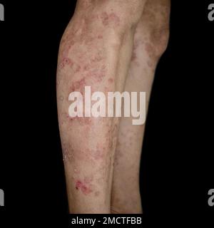 Pilzinfektion genannt Tinea corporis in Bein der asiatischen Frau. Weit verbreiteter Ringwurm über den unteren Extremitäten. Stockfoto