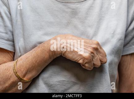 Volkmann-Kontraktur in der linken oberen Extremität einer südostasiatischen Frau. Es ist eine permanente Verkürzung der Unterarmmuskulatur, die zu einem klauenähnlichen Po führt Stockfoto