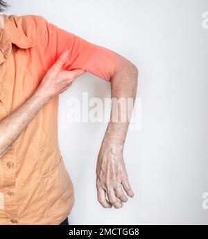 Schmerzen im Schultergelenk und Arm einer südostasiatischen Alten. Konzept der gefrorenen Schulter. Stockfoto