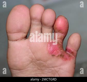 Pilzinfektion Tinea pedis am Fuss einer asiatischen Frau. Es ist eine juckende Läsion. Stockfoto