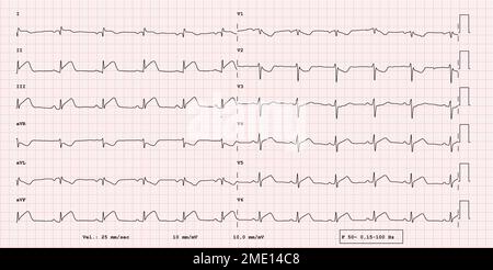 EKG Beispiel F r 12 Kanal Rhythmus Linksschenkelblock Reale EKG Beispiel F r 12 Kanal Rhythmus Linksschenkelblock Reale