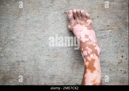 Das Bein des alten Mannes mit Hauterkrankung, die zu Melaninverlust in Innenräumen führt. Das Fussmodell im schwarzen Tanktop mit Vitiligo-Syndrom. Stockfoto