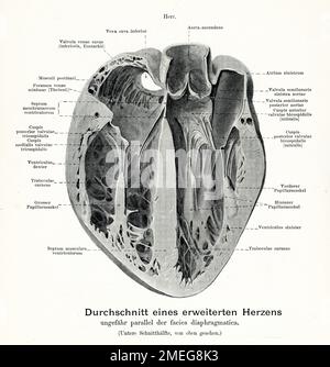 Vintage-Illustration von Anatomie, Herzmuskulatur: Abschnitt parallel zu den Facies diaphragmatica mit erweitertem Herzen, deutsche anatomische Beschreibungen Stockfoto