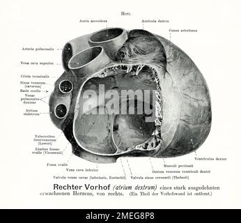 Vintage-Darstellung der Anatomie ein erwachsener rechter Herzvorhof mit starker Dilatation, mit deutschen anatomischen Beschreibungen Stockfoto