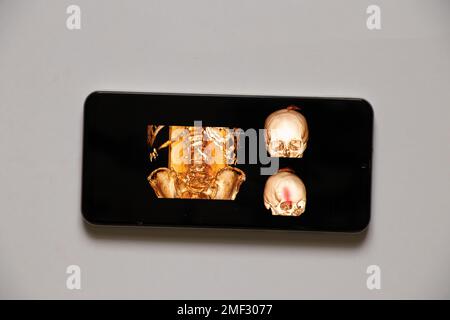 Computertomographie der Wirbelsäule eines alten Mannes mit Osteochandrose mit einem gebrochenen Wirbel und deren Verschiebung und einem Schädel mit einem gebrochenen für Stockfoto