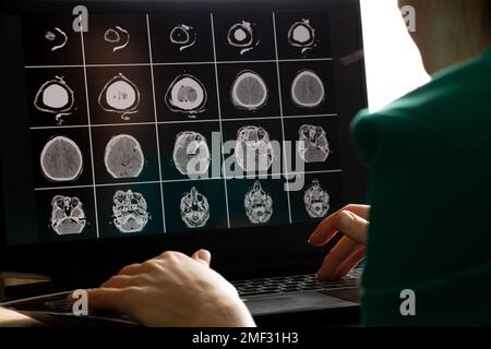 3D Computertomographie des Gehirns mit einem Bruch des frontalen Schädelteils nach einer Verletzung auf Laptop-Bildschirmen auf dem Tisch auf Laptop-Bildschirmen bei Stockfoto