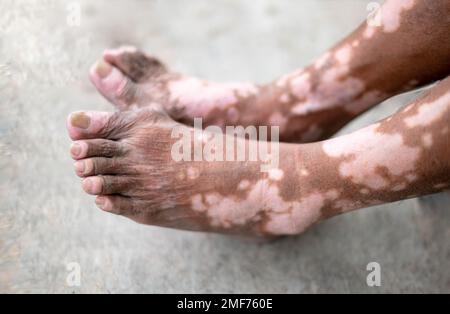 Das Bein des alten Mannes mit Hauterkrankung, die zu Melaninverlust in Innenräumen führt. Das Fussmodell im schwarzen Tanktop mit Vitiligo-Syndrom. Stockfoto