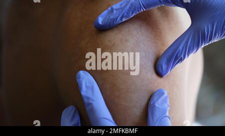 Der Arzt untersucht die Hauterkrankung seines Patienten Nahaufnahme. Stockfoto