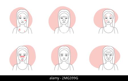 Liniensymbole für Hautprobleme legen die Vektordarstellung fest. Skizzen von Frauen mit Falten und Melasma, Pickel-Infektion und öliger Schwarzkopfpore, Rosazea auf Mädchengesicht in der Infografik-Sammlung Stock Vektor