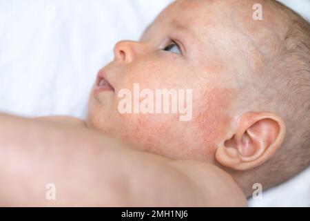 Gesicht eines Jungen mit roten gereizten Flecken am linken Ohr und an der Wange, atopischer Dermatitis, Blasen auf empfindlicher Haut im Fokus, ein Kind, das auf einem weißen Tuch liegt, mit entzündeter Haut im Gesicht, Kopf, Stirn Stockfoto