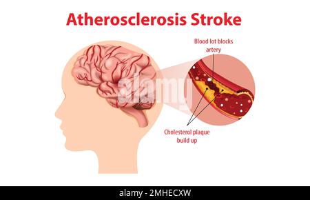 Menschliche Anatomie mit Atherosklerose-Schlaganfall Stock Vektor