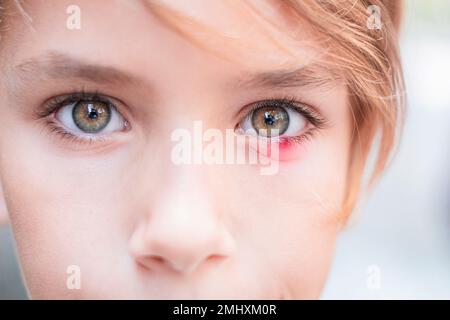 Nahaufnahme eines Kinderaugenblicks. Die ophthalmologische Hordeolumkrankheit. Stockfoto