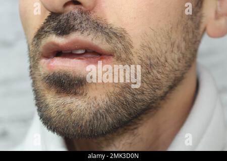 Herpes-Infektion an den Lippen eines Mannes. Nahaufnahme und selektiver Fokus auf Herpes-Infektion. Stockfoto